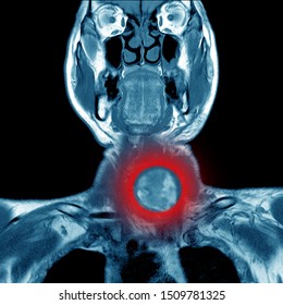 Magnetic Resonance Imaging (MRI) Of Neck,case Of Neck IMPRESSION:-Deep Neck Infection In Retropharyngeal Space Cyst At Lower Pole Of Lt Lobe Of Thyroid