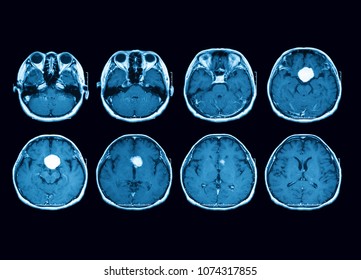 Magnetic Resonance Imaging (MRI) Scan Of The Brain, Transverse View, Case Of Pituitary Mass