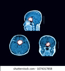 Magnetic Resonance Imaging (MRI) Scan Of The Brain (sagittal, Transverse And Coronal Views), Case Of Pituitary Mass.