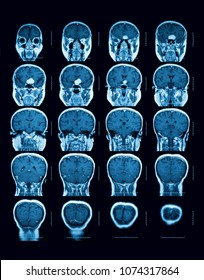 Magnetic Resonance Imaging (MRI) Scan Of The Brain, Coronal View, Case Of Pituitary Mass