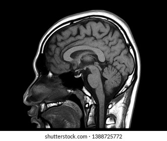 Magnetic resonance imaging or MRI scan of normal human brain, head in sagittal view, showing corpus callosum, midbrain, pons, medulla, cerebrum and cerebellum. Medical film.