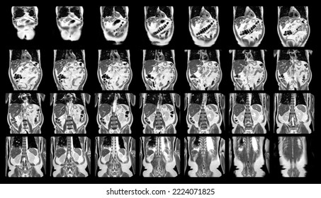 Magnetic resonance imaging (MRI)OF UPPER ABDOMEN of a patient who has suspected mass-forming hilar cholangiocarcinoma Coronal view science and education.Medical Technology and Science concept. - Shutterstock ID 2224071825