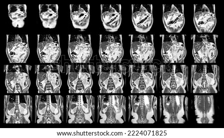Magnetic resonance imaging (MRI)OF UPPER ABDOMEN of a patient who has suspected mass-forming hilar cholangiocarcinoma Coronal view science and education.Medical Technology and Science concept.
