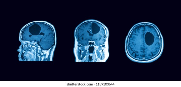 Magnetic resonance imaging (MRI-scan) of the brain, left to right: sagittal, coronal and axial (transverse) viwes