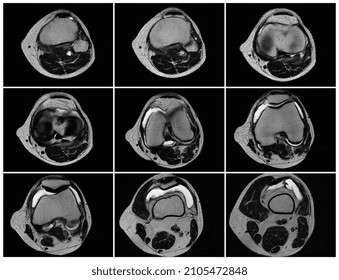 Magnetic Resonance Imaging ,MRT Images Of Knee.Acute Psoriatic Arthritis, Arthrosis .Excess Synovial Fluid In And Around The Left Knee Joint