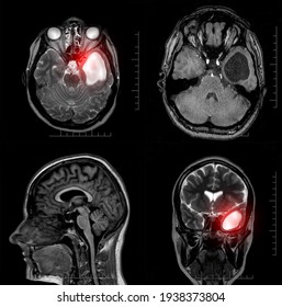 Magnetic Resonance Imaging Of A Patient With A Temporal Horn Cyst Of The Left Lateral Ventricle Of The Brain. Atrophic Changes In The Temporal Lobe. Arachnoid Cyst