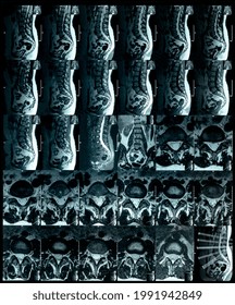 Magnetic Resonance Imaging Of The Spine Showing Multiple Intramedullary