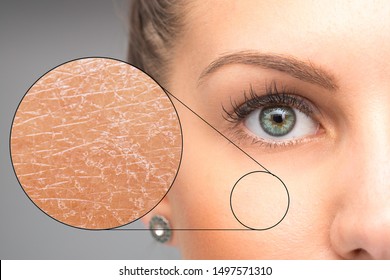 A magnified macro detailed circle is seen over the cheek of a beautiful caucasian girl, closer inspection of the skin shows dry and flaky skin, in need of dermatologist. - Shutterstock ID 1497571310