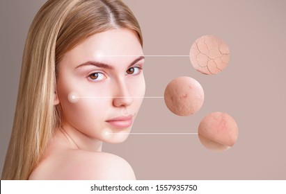 Magnifying Circles Demonstrate Couperose And Acne On Face Skin Of Young Woman. Over Beige Background.