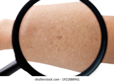 Magnifying Glass On Arm With Small White And Brown Spots On The Skin Of Senior Man Arm (Idiopathic Guttate Hypomelanosis). Isolated On White Background.