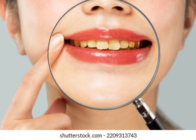 Magnifying a woman's yellowed teeth with a loupe. - Shutterstock ID 2209313743