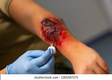 Make Up Burn Wound On A Victim