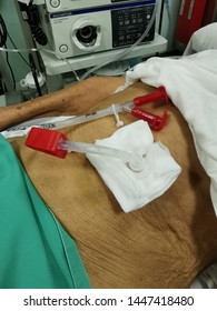 Malacca, Malaysia : 09/05 /2019 :PEG Tube Being Placed At The Gastric Via Endoscopic Technique Under Aseptic Precaution.