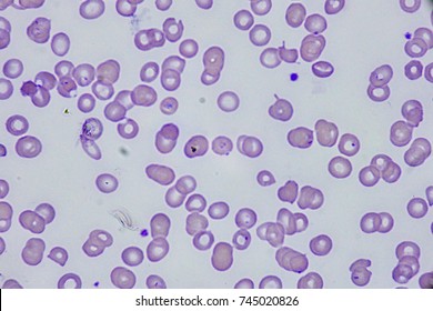 Malaria (Plasmodium Falciparum)