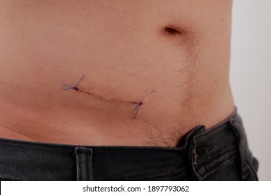 Male Abdomen With Suture Operation Appendicitis