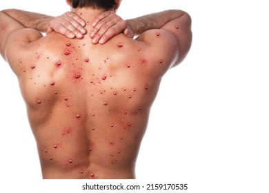 Male back affected by blistering rash because of monkeypox or other viral infection on white background