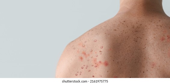 Male back affected by blistering rash because of monkeypox or other viral infection on white background