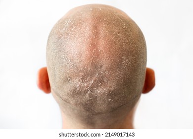 Male Bald Flaky Head With Dandruff Close-up, Back View. White Background. The Concept Of Psoriasis And Skin Problems.