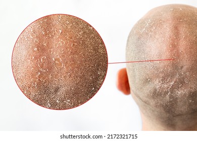 Male Bald Flaky Head With Dandruff Close-up, Back View. White Background With Zoomed Area Of Skin Problem. The Concept Of Psoriasis And Seborrheic Dermatitis.