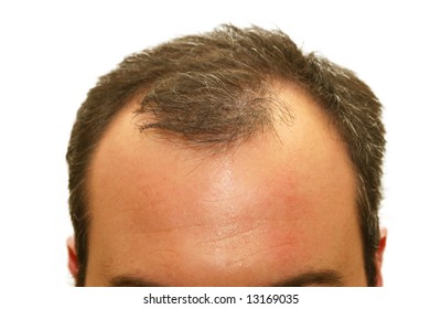 Male Balding Head