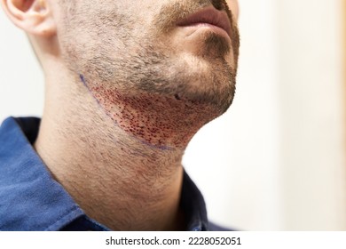 Male beard after hair transplant surgery - Shutterstock ID 2228052051