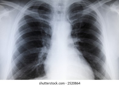 Chest X Ray Thoracic Image Showing Stock Photo (Edit Now) 1568339251