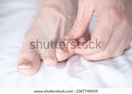 Male cut nails with nail fungus. Fungal infection on nails legs, finger with onychomycosis. Care and treatment. Closeup of a foot with damaged nails because of fungus
