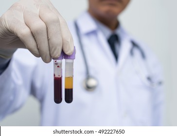 Male Doctor Or Technician Holding Compared Red Blood (whole Blood) And Centrifuge Blood In Test Tubes For The Sample. It Is Real Human Blood. Health And Medical, Blood Analyzing Concept.