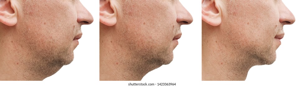 Male Double Chin   After Treatment