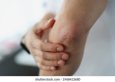 Male Elbow And Flaky Skin And Psoriasis