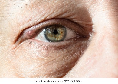 Male Eye With Thickening On Eyelid From Chalazion Closeup