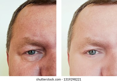 Male Eye Wrinkles Before And After Procedures