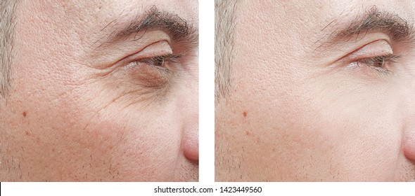 Male Eyes Wrinkles   After Treatment