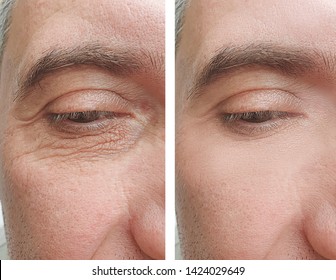 Male Eyes Wrinkles   After Treatment