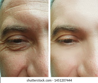 Male Eyes Wrinkles Before And After Treatment