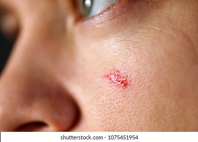 Skin Abrasion Images, Stock Photos & Vectors 