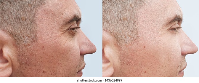 Male Face Wrinkles   After Treatment