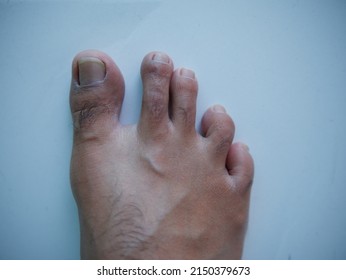 Male Feet With Long Toenails.