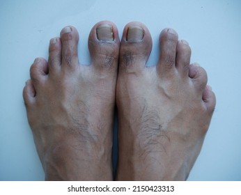 Male Feet With Long Toenails.