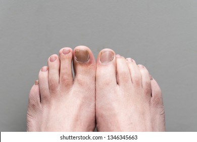 Male Feet Onychomycosis With Fungal Nail Infection