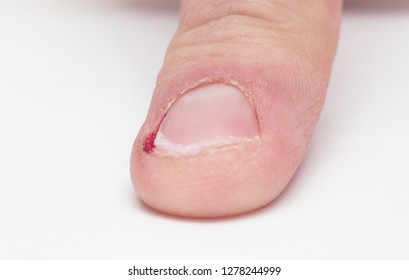 Male finger with torn burr and nail with blood, nail biting, white background, injury, copy space, macro - Shutterstock ID 1278244999