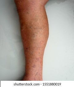 Male Foot And Leg, Showing Purple, Mottled Skin (Livedo Reticularis)