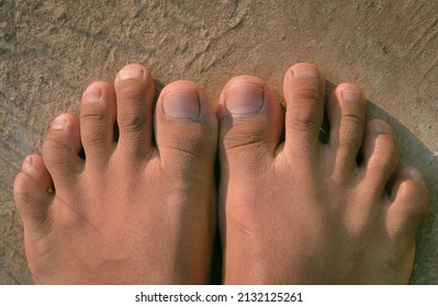 Male Foot with second toe longer than a big toe. LaMay toe, Morton's foot and Greek foot.