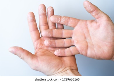 Male Hand On A White Background, Peeling Of The Skin Of The Hands From The Inside Of The Palm, Allergies And Dry Skin, Symptoms Of Monkey Pox