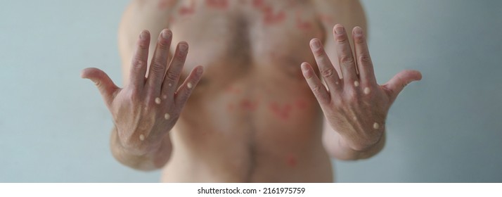 Male hands affected by blistering rash because of monkeypox or other viral infection on wide background