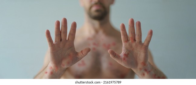 Male hands affected by blistering rash because of monkeypox or other viral infection on white background
