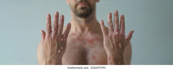 Male hands affected by blistering rash because of monkeypox or other viral infection on white background - Shutterstock ID 2161975791