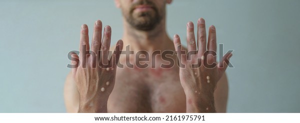 Male hands affected
by blistering rash because of monkeypox or other viral infection on
white background
