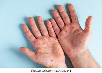 Male Hands Monkeypox Rash Patient Monkeypox Stock Photo 2177951441 ...