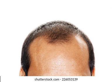Thinning Hair Man Images Stock Photos Vectors Shutterstock